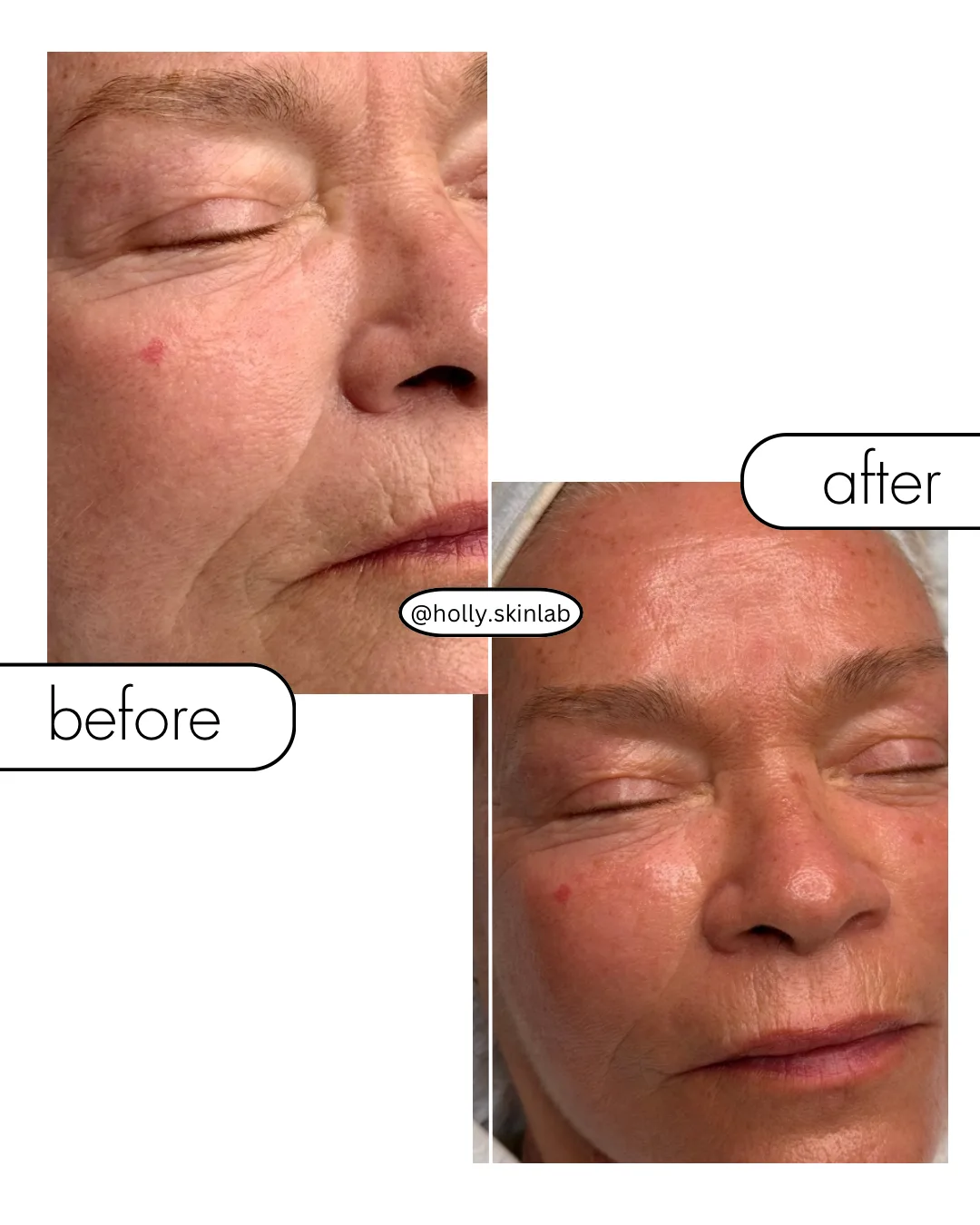 Vorher-Nachher-Aufnahme einer Dermalogica-Hautbehandlung im Holly Skinlab